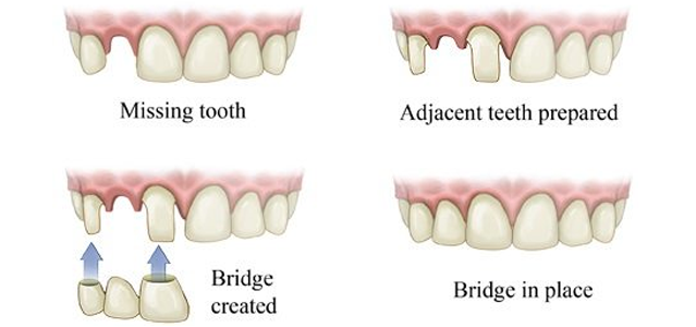 About Dental Bridges