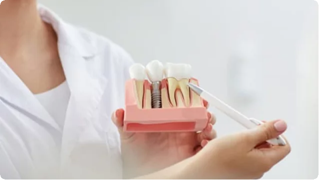 About dental implants