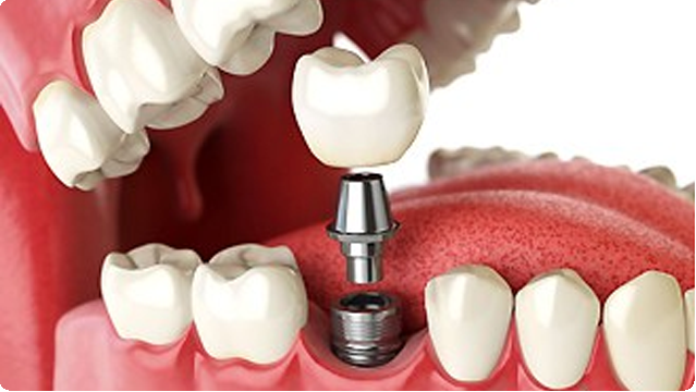 Why Dental Implants may be great for you