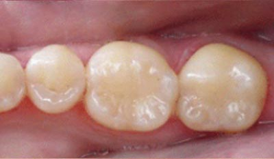 Amalgam Fillings