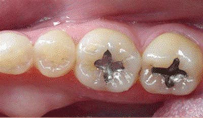 Composite Fillings