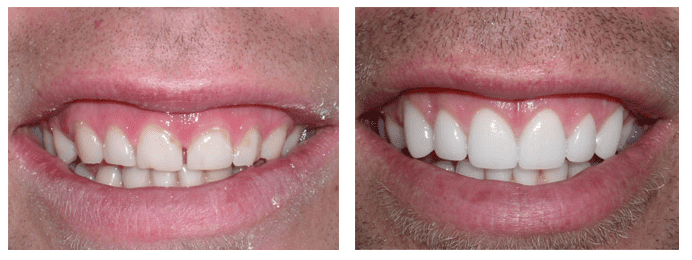 Dental Veneers before and after