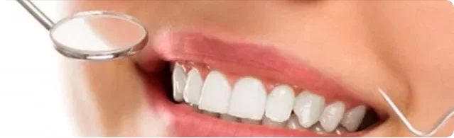 Dental Veneers