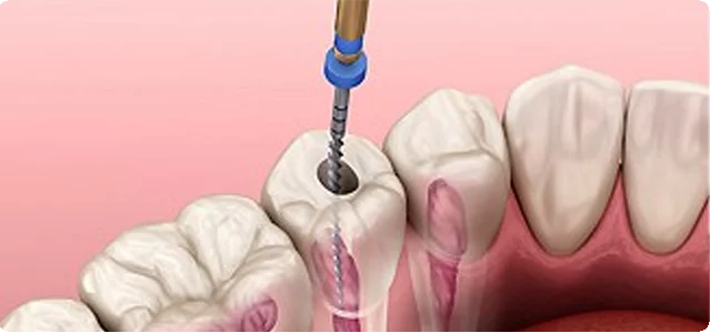 Root Canal Treatment