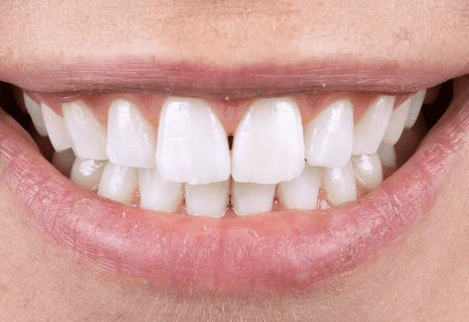 Whitening after